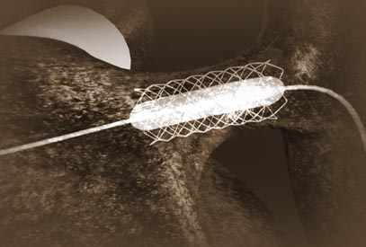 Ductus Arteriosis Endoscopic Surgery Stint Medical Visualization Animation