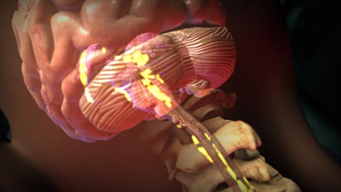 New York CHAM Spine Tumor Surgery Medical Animation